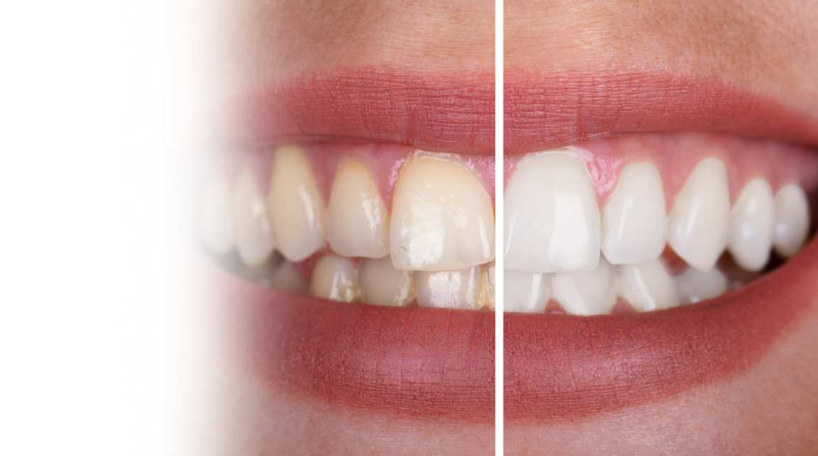 Teeth Whitening in Mysore at Umbrella Aesthetics